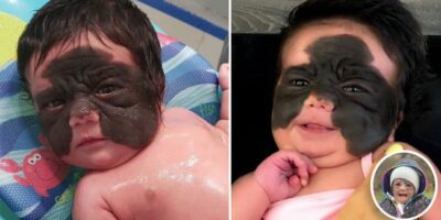 2-year-old finally has “Batman” birthmark removed after ground-breaking surgery