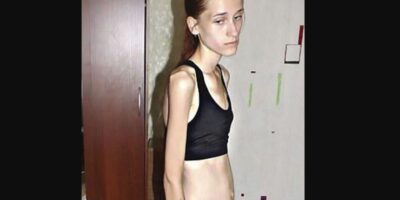 An 18-year-old girl with anorexia weights 70 pounds, demonstrating the power of motivation and perseverance.