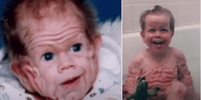Tomm Tennent: The unique baby born with enough skin to cover the body of a five-year-old child