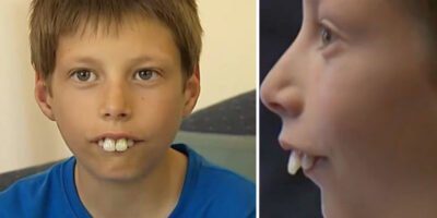 Kid bullied for his teeth problem, now has a new smile.
