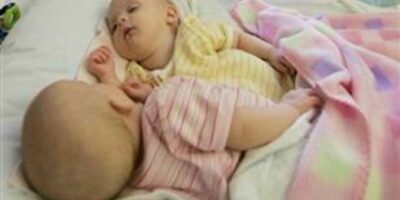 Conjoined twins Physically, Bella and Abby were connected from birth, but surgery permanently changed everything.