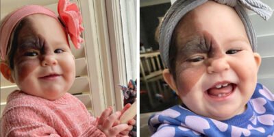 Mom on a mission to show daughter with extremely rare birthmark that she is beautiful