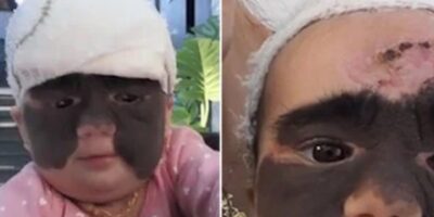 2 year old Luna finally gets her “Batman birthmark” removed after a surgery