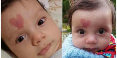 Baby born with ‘heart’ birthmark became world famous in 2015 – here’s what he looks like 4 years later