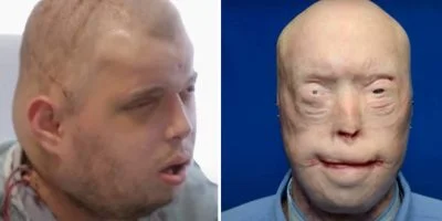 Patrick Hardison received a new face after third-degree burns, this is him today