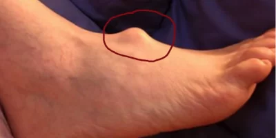 A lady spotted a lump on her foot when she was 15 years old, but she chose to ignore it.