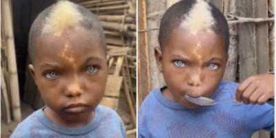 Little boy with natural blue eyes, white hairs and lightning mark down his face goes viral