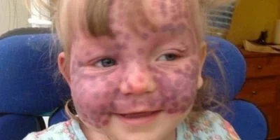 Parents respond to strangers who jump to hurtful conclusions because of their daughter’s rare skin disease